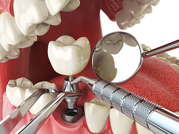 Best Emergency Broken Tooth Repair in Wells, MN
